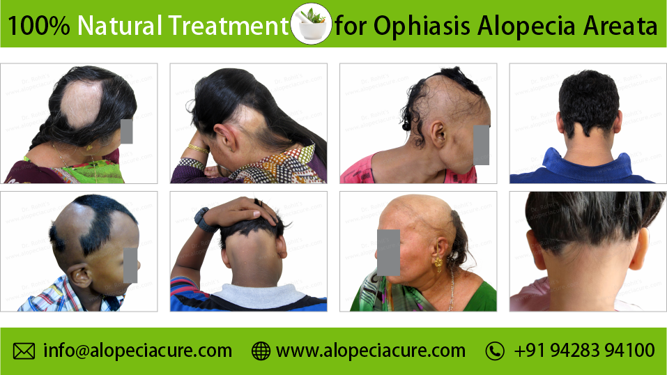 ophiasis alopecia